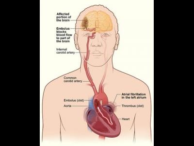 images accidente vasculare